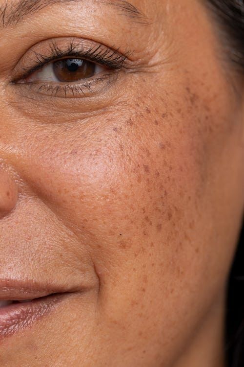 Dark Spots & Dark Circles